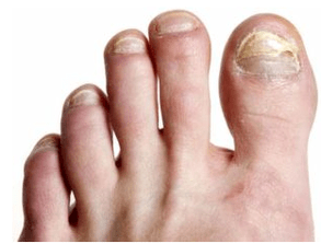 Hongo de uñas