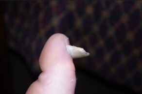 Síntomas de hongos en las uñas