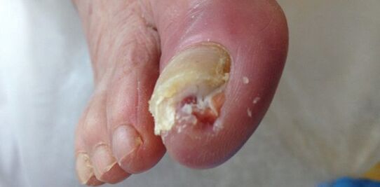 El depósito y la fuente de hongos dermatofíticos es una persona enferma