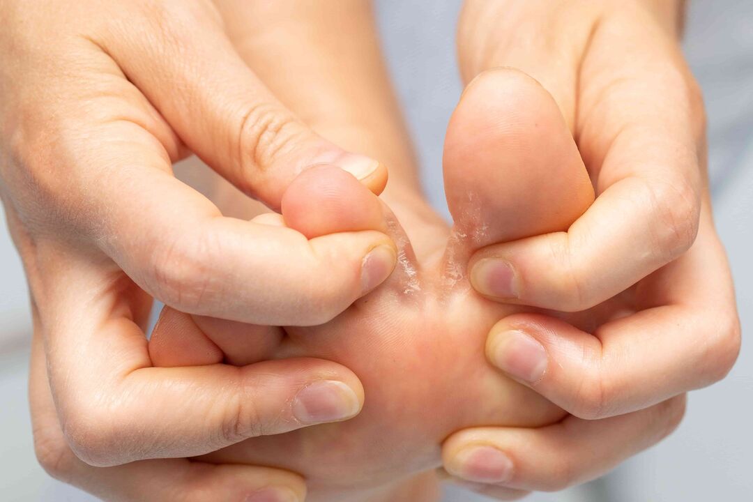 hongo entre los dedos de los pies y su tratamiento con crema Demyxil